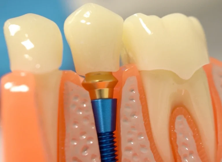 Chi non può fare un impianto dentale